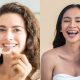 Invisalign vs. Braces: Which is the Better Option?