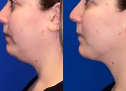 What Are The Advantages Of A Non-Surgical Neck Lift With Kybella?