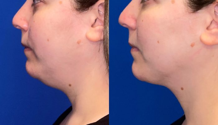 What Are The Advantages Of A Non-Surgical Neck Lift With Kybella?