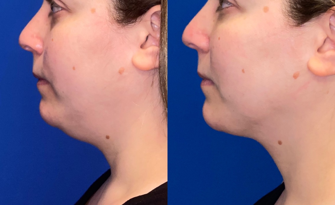 What Are The Advantages Of A Non-Surgical Neck Lift With Kybella?