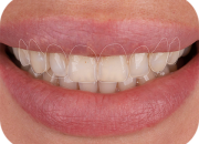 Visit Reputed Dentists Assisting with Laser Teeth Whitening and Cleaning Treatments