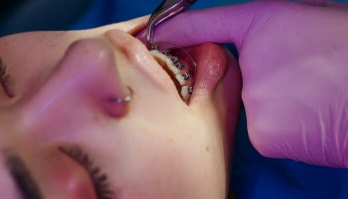 Understanding the Importance of Orthodontic Retainers