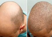 Hair Transplant Cost in Turkey