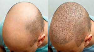 Hair Transplant Cost in Turkey