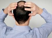 3 Insights for Men Struggling with Male Pattern Baldness