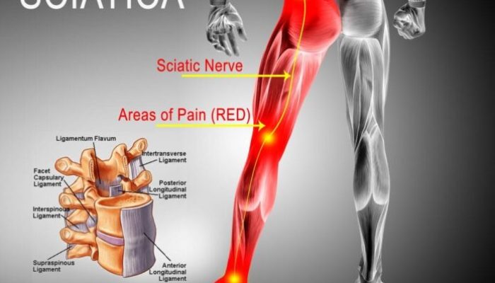 What Is the Best Massager for Sciatica Pain: Top Picks