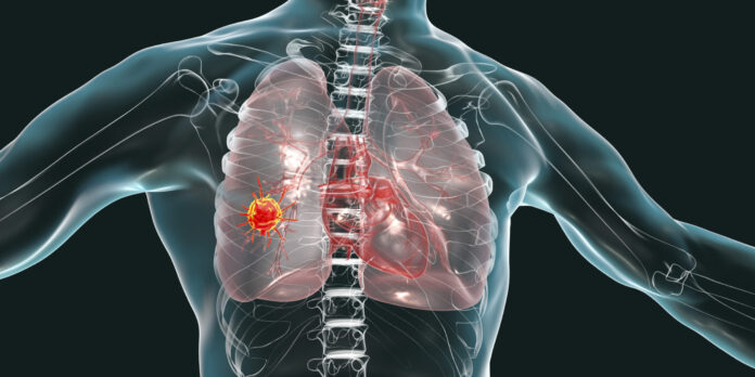 Symptoms of mesothelioma