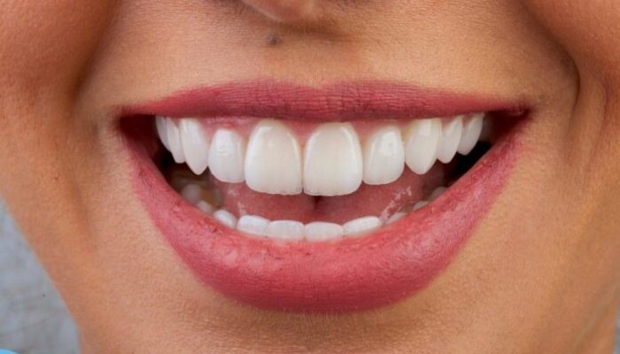 How Much Do Veneers Cost? A Guide to Smile Transformation Expenses