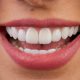 How Much Do Veneers Cost? A Guide to Smile Transformation Expenses