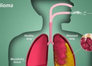 Why You Shouldn’t Wait to See a Doctor if You Have Mesothelioma Symptoms