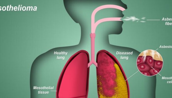 Why You Shouldn’t Wait to See a Doctor if You Have Mesothelioma Symptoms