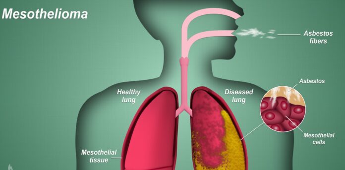 Why You Shouldn’t Wait to See a Doctor if You Have Mesothelioma Symptoms