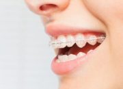 Innovations in Teeth Straightening Techniques: A Comprehensive Guide