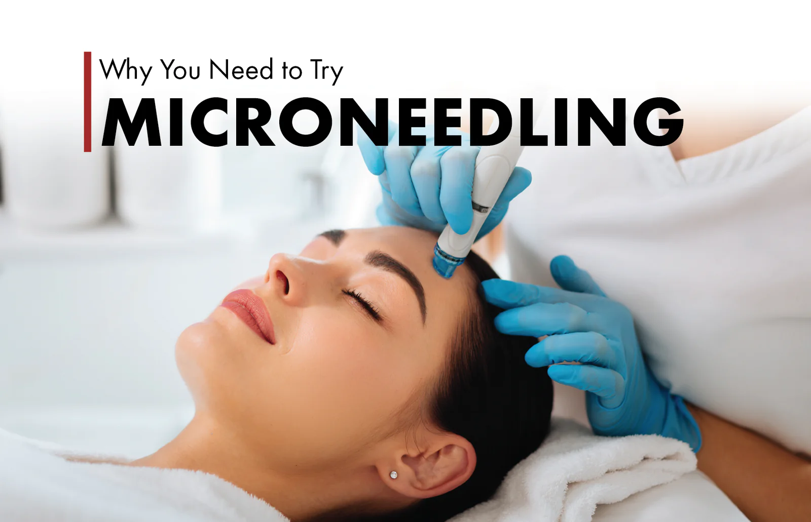 Microneedling 