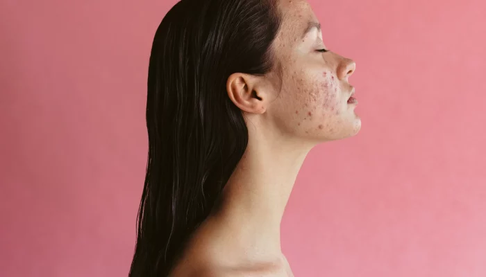 10 Game-Changing Ways Women Can Tackle Hormonal Acne