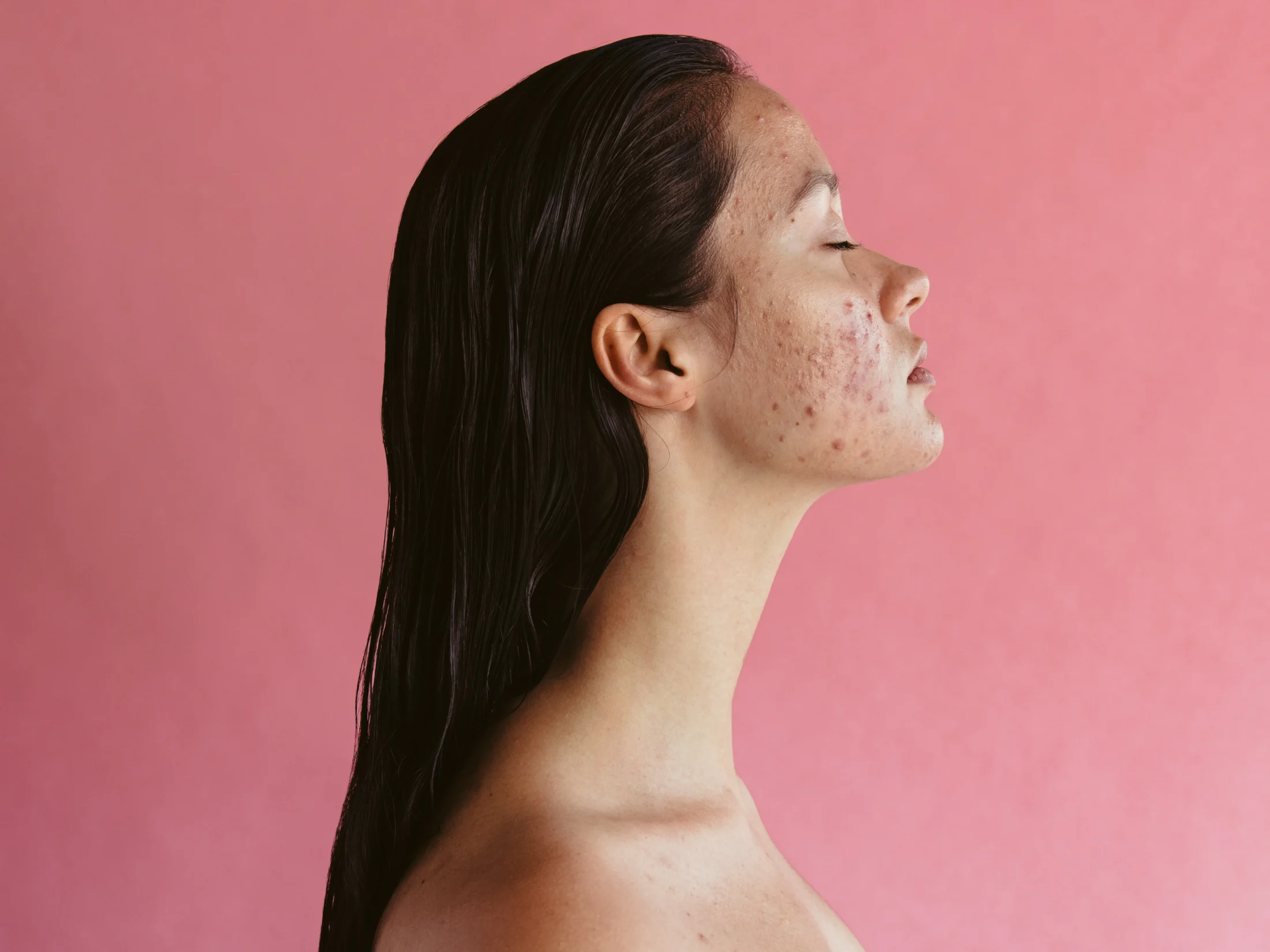 10 Game-Changing Ways Women Can Tackle Hormonal Acne